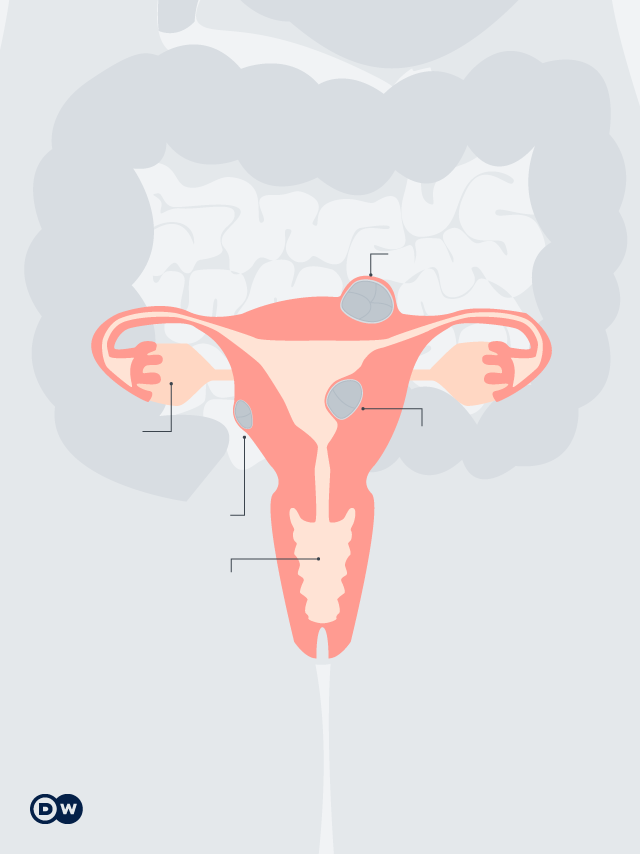 Sangramento em excesso na menstruação pode ser mioma; entenda