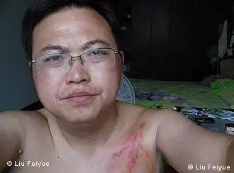 Der Menschenrechtler Liu Feiyue in Suizhou, Hubei wurde am 31.07.2011 von einer Überwachungskraft schwer verprügelt. Bild aufgenommen von: Liu Feiyue Datum:31.07.2011 Rechte zur Nutzung des Bildes gewährt von: Liu Feiyue