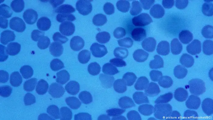 Les globules rouges d'un drépanocytaire ont une forme anormale de faucille