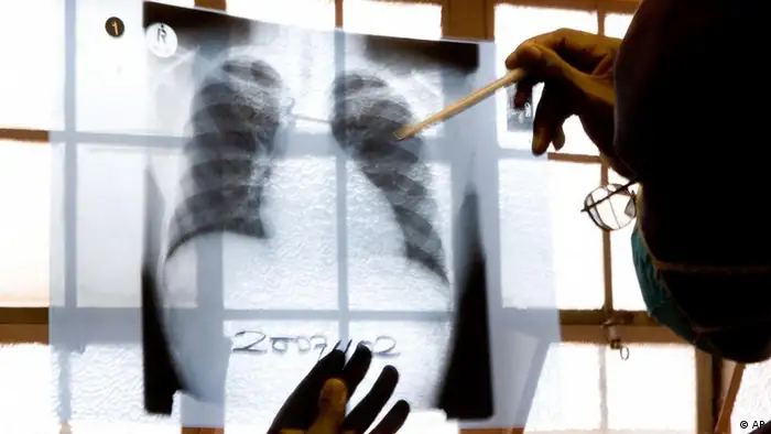 A doctor examines chest X-rays at a tuberculosis clinic in Gugulethu, Cape Town, South Africa, Friday, Nov. 9, 2007. South Africa reported 343,000 TB cases in 2006, of which an estimated 6,000 were multi-drug-resistant. The government says that there have been about 400 cases of XDR-TB (extremely-drug-resistant tuberculosis), but groups like Medecins Sans Frontieres say this is a big underestimate. (ddp images/AP Photo/Karin Schermbrucker)