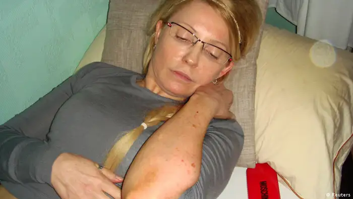 REFILE - AMENDING RESTRICTIONS Former Ukrainian Prime Minister Yulia Tymoshenko shows what she claims is an injury in the Kachanivska prison in Kharkiv, in this undated handout picture received by Reuters on April 27, 2012. Ukrainian President Viktor Yanukovich, under fire from European politicians over the treatment of his jailed opponent Tymoshenko, has ordered prosecutors to investigate her alleged beating by prison guards last week, he said on Thursday. REUTERS/Handout (UKRAINE - Tags: CIVIL UNREST POLITICS HEALTH CRIME LAW) FOR EDITORIAL USE ONLY. NOT FOR SALE FOR MARKETING OR ADVERTISING CAMPAIGNS. THIS IMAGE HAS BEEN SUPPLIED BY A THIRD PARTY. IT IS DISTRIBUTED, EXACTLY AS RECEIVED BY REUTERS, AS A SERVICE TO CLIENTS