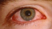 كيف يمكن لمستخدمي العدسات اللاصقة تجنب التهاب ملتحمة العين؟