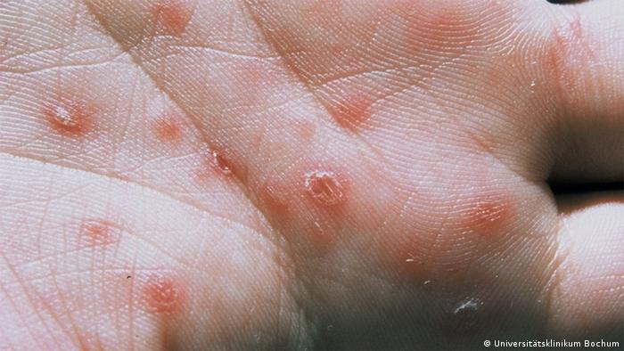 Kiła - jedna z najczęstszych chorób wenerycznych 