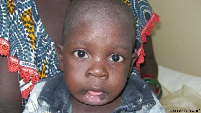 Un enfant de Guinée-Bissau victime du noma, après un an de traitement réparateur