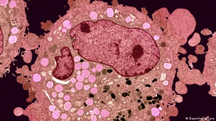 Krebs: Krebszellen unter einem Mikroskop (BayerHealthcare)
