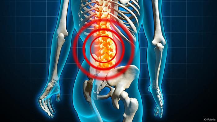 آلام أسفل الظهر أسبابها وطرق علاجها علوم وتكنولوجيا آخر الاكتشافات والدراسات من Dw عربية Dw 24 11 2013