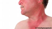 نصائح لعلاج حروق الجلد الناتجة عن الشمس