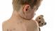 Kind mit Masern (Foto: Fotolia.com) Kind mit Masern (Foto: Fotolia.com)