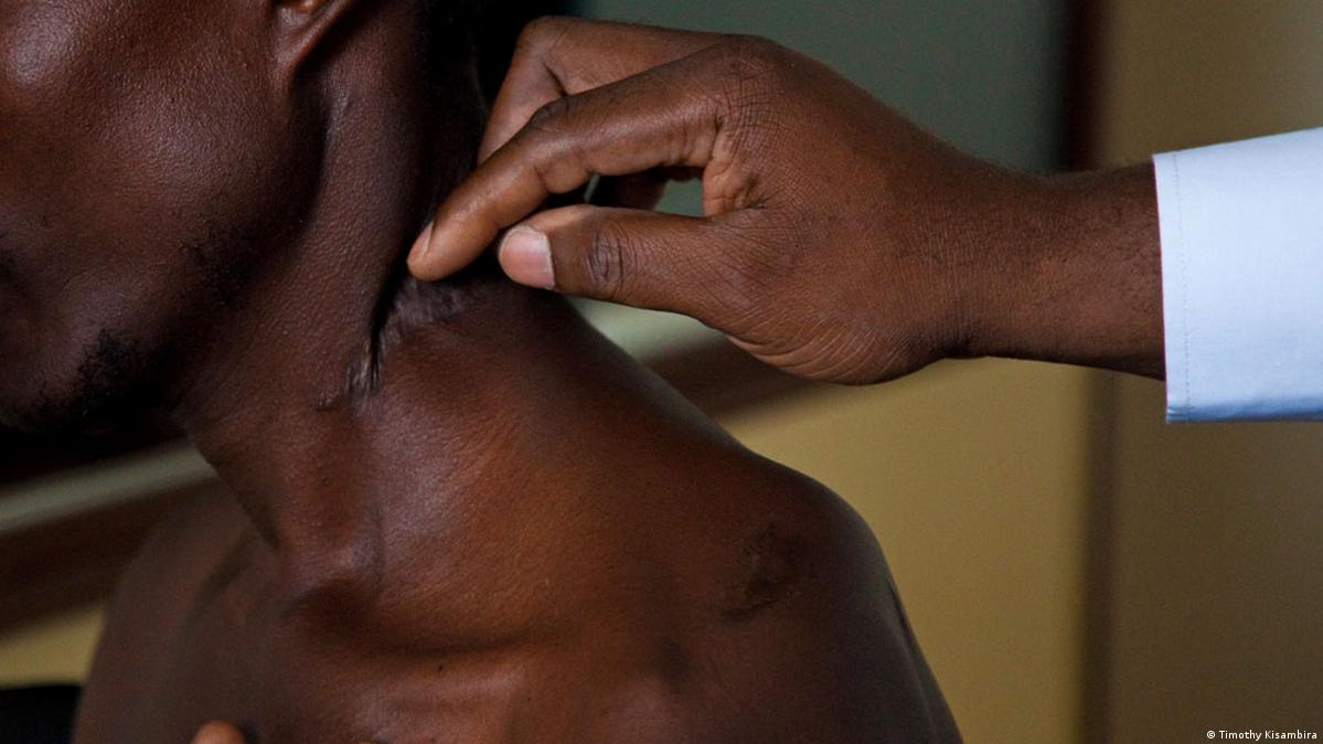 Scar on the neck of a victim of a genocidal attack