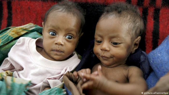 Zwillinge in Äthiopien (picture-alliance/dpa)