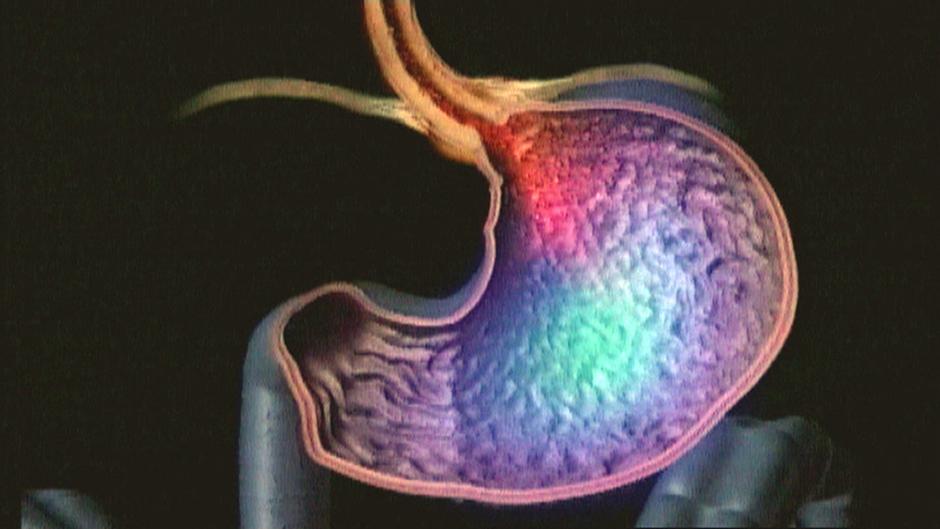 Preventing Esophageal Cancer DW 12/05/2013