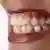 Symbolbild Zähneknirschen