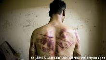 A Syrian man shows marks of torture on his back, after he was released from regime forces, in the Bustan Pasha neighbourhood of Syria's northern city of Aleppo on August 23, 2012. State media hailed the recapture by the army of three Christian neighbourhoods in the heart of Aleppo, but clashes between troops and rebel fighters raged in other parts of the city and in the southern belt of Damascus. AFP PHOTO / JAMES LAWLER DUGGAN (Photo credit should read JAMES LAWLER DUGGAN/AFP/GettyImages)
