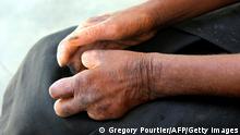 TO GO WTIH AFP STORY BY GREGORY POURTIER --- The hands of a Madagascan woman named Mirana (which means 'joy' in Madagascan), are seen as she sits on January 29, 2011 in the main treatment center for leprosy in Tulear, in southwestern Madagascar. Madagascar, along with India, Brazil, Mozambique, and Angola in particular, is one of the countries most affected by this disease, which has been eradicated in many other parts of the world. In this huge island in the Indian Ocean, the Tulear region is among the most affected: 231 patients were screened in 2010, or 1.87 of the 10,000 inhabitants. AFP PHOTO/ Gregory POURTIER (Photo credit should read Gregory POURTIER/AFP/Getty Images)