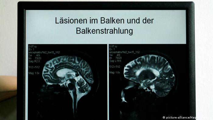 MRT-Aufnahme eines an Multipler Sklerose erkrankten Gehirns