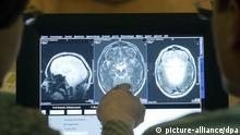 جهاز جديد يقلل فقدان الذاكرة لدى مرضى الزهايمر