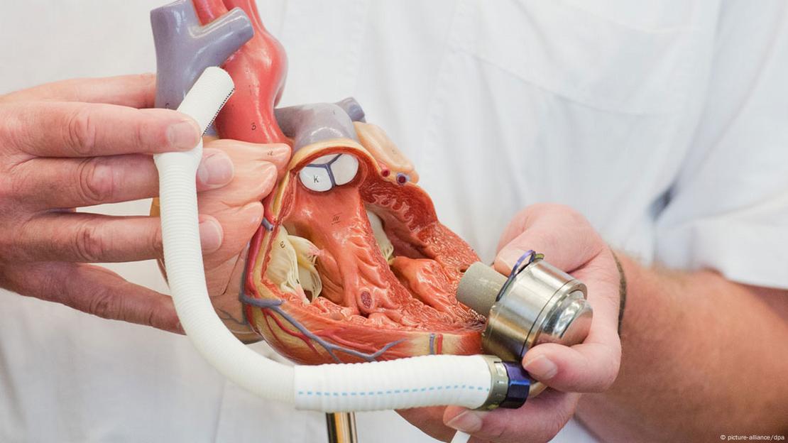 Το σύστημα τεχνητής υποβοήθειας της καρδιάς "Heartmate III"