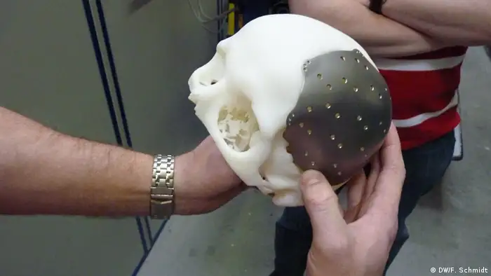 Schädelimplantat aus dem 3D Drucker