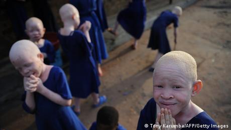 Symbolbild Albinos in Afrika