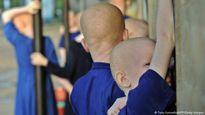 Crianças albinas. Foto simbólica