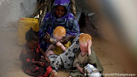 Албиносите в Африка водят крайно опасен живот Суеверията ги обявяват