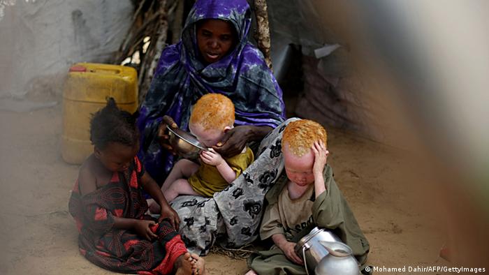 Албиносите в Африка водят крайно опасен живот. Суеверията ги обявяват