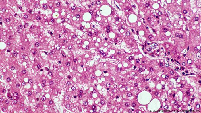 Microscope image of fatty liver (picture-alliance/A.& H.-F.Michler/OKAPIA)