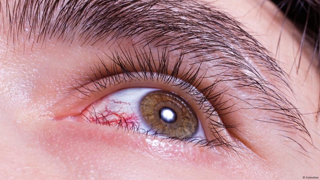 متى يصبح احمرار العين علامة خطر؟