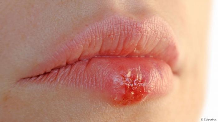 Behandlung intim herpes STD Facts