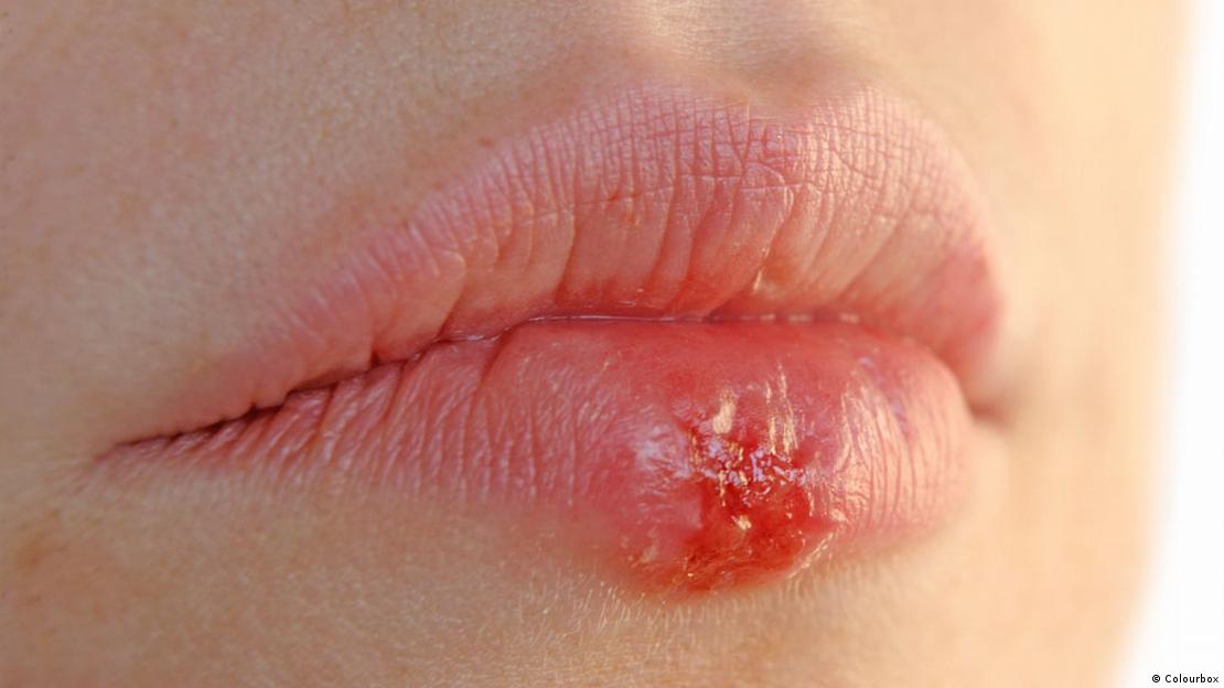 Retki su oni kojima povremno ne izbiaj groznica