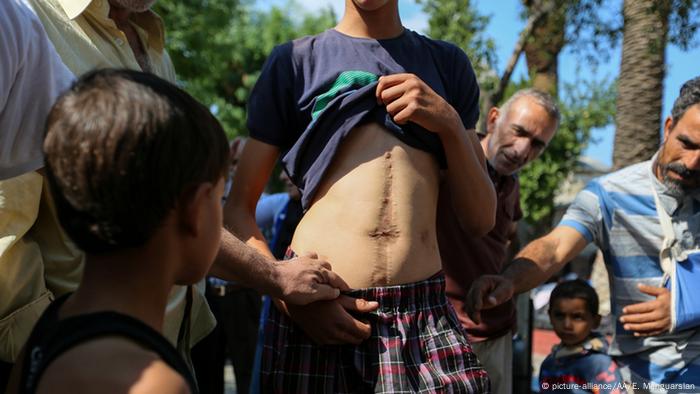Syrian refugee showing his scar 