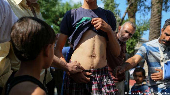 Syrischer Flüchtlingsjunge in der Türkei zeigt seine Narben (Foto: Emin Menguarslan / Anadolu Agency) 