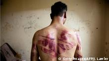 August 23, 2012. A Syrian man shows marks of torture on his back, after he was released from regime forces, in the Bustan Pasha neighbourhood of Syria's northern city of Aleppo on August 23, 2012. State media hailed the recapture by the army of three Christian neighbourhoods in the heart of Aleppo, but clashes between troops and rebel fighters raged in other parts of the city and in the southern belt of Damascus. AFP PHOTO / JAMES LAWLER DUGGAN Getty Images/AFP/J. Lawler