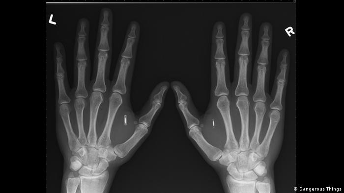 X-ray of two hands showing biohacking implants