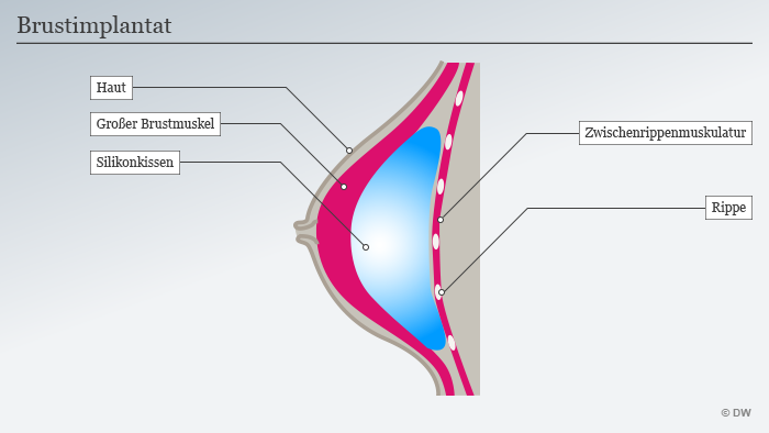 Brustimplantate: Was Steckt Drin Und Was Sind Die Risiken? | Wissen ...