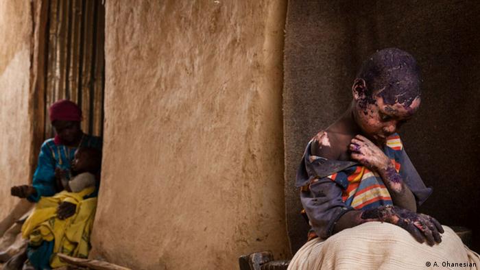 Little boy with burns is looked after by his mother; Copyright: Adriane Ohanesian 