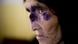 Afghanistan Kabul Frau mit Leishmaniasis Leishmaniose Afghanistan Kabul Frau mit Leishmaniasis Leishmaniose