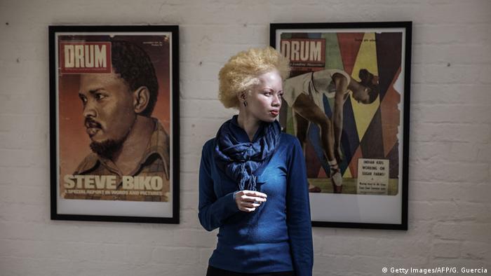 Südafrika Albinismus - Model und Juristin Thando Hopa (Foto: AFP)