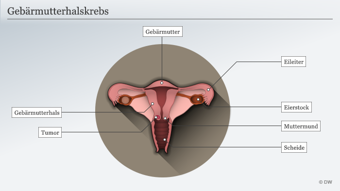 Infografik Gebärmutterhalskrebs