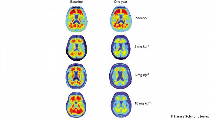 Nature Scientific Journal - Gehirn-Bilder Alzheimer