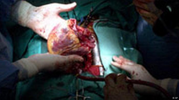 Human heart transplant