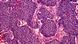 Medizin Pathologie - Pankreaskarzinom Medizin Pathologie - Pankreaskarzinom