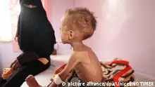 الأمم المتحدة: إننا نخسر الحرب ضد المجاعة في اليمن