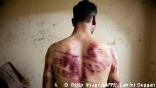 23.08.2012 A Syrian man shows marks of torture on his back, after he was released from regime forces, in the Bustan Pasha neighbourhood of Syria's northern city of Aleppo on August 23, 2012. State media hailed the recapture by the army of three Christian neighbourhoods in the heart of Aleppo, but clashes between troops and rebel fighters raged in other parts of the city and in the southern belt of Damascus. AFP PHOTO / JAMES LAWLER DUGGAN (Photo credit should read JAMES LAWLER DUGGAN/AFP/GettyImages)