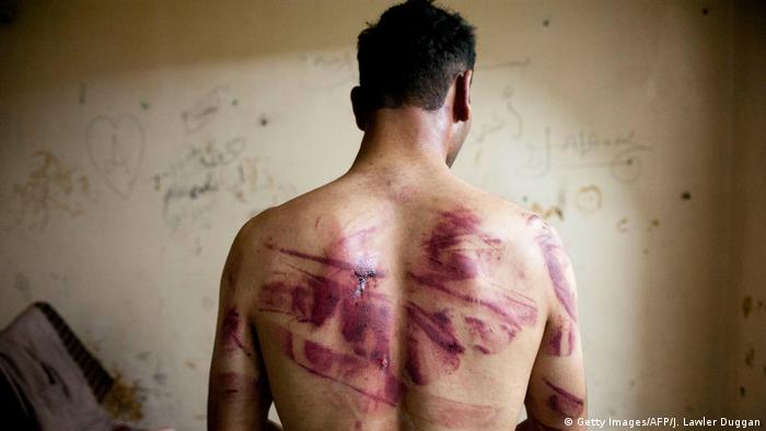 A Syrian man shows marks of torture on his back, after he was released from regime forces