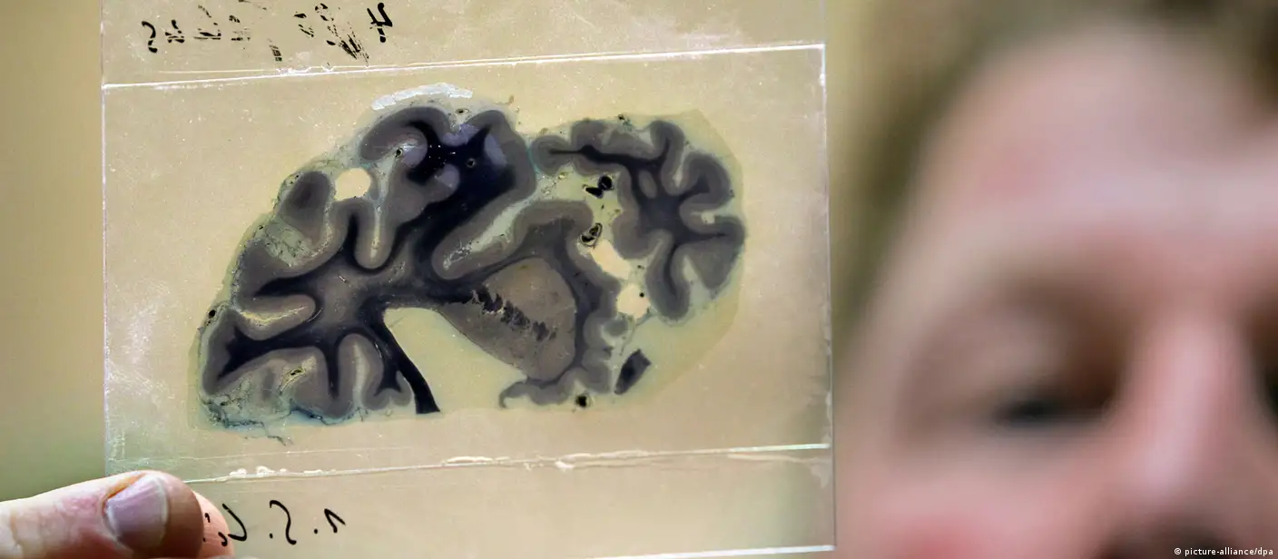 Identifying Nazi victims from brain slides