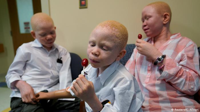 USA Prothesen für Kinder mit Albinismus aus Tansania (Reuters/C. Allegri)