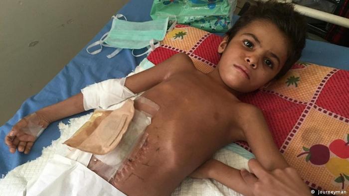 Ребенок, пострадавший в результате авиаудара в Йемене