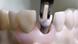 Tooth implant Tooth implant