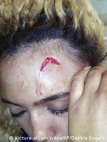 Model Gabriella Engels shows the wound on her head